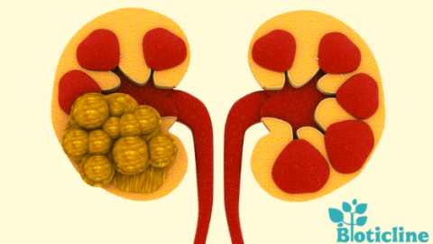 Home Remedies For Kidney Stones